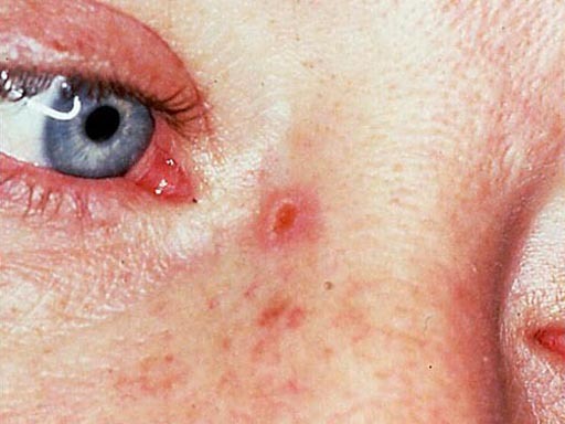 Dysplastic Nevus Skin Cancer Or Mole How To Tell Pictures Cbs News