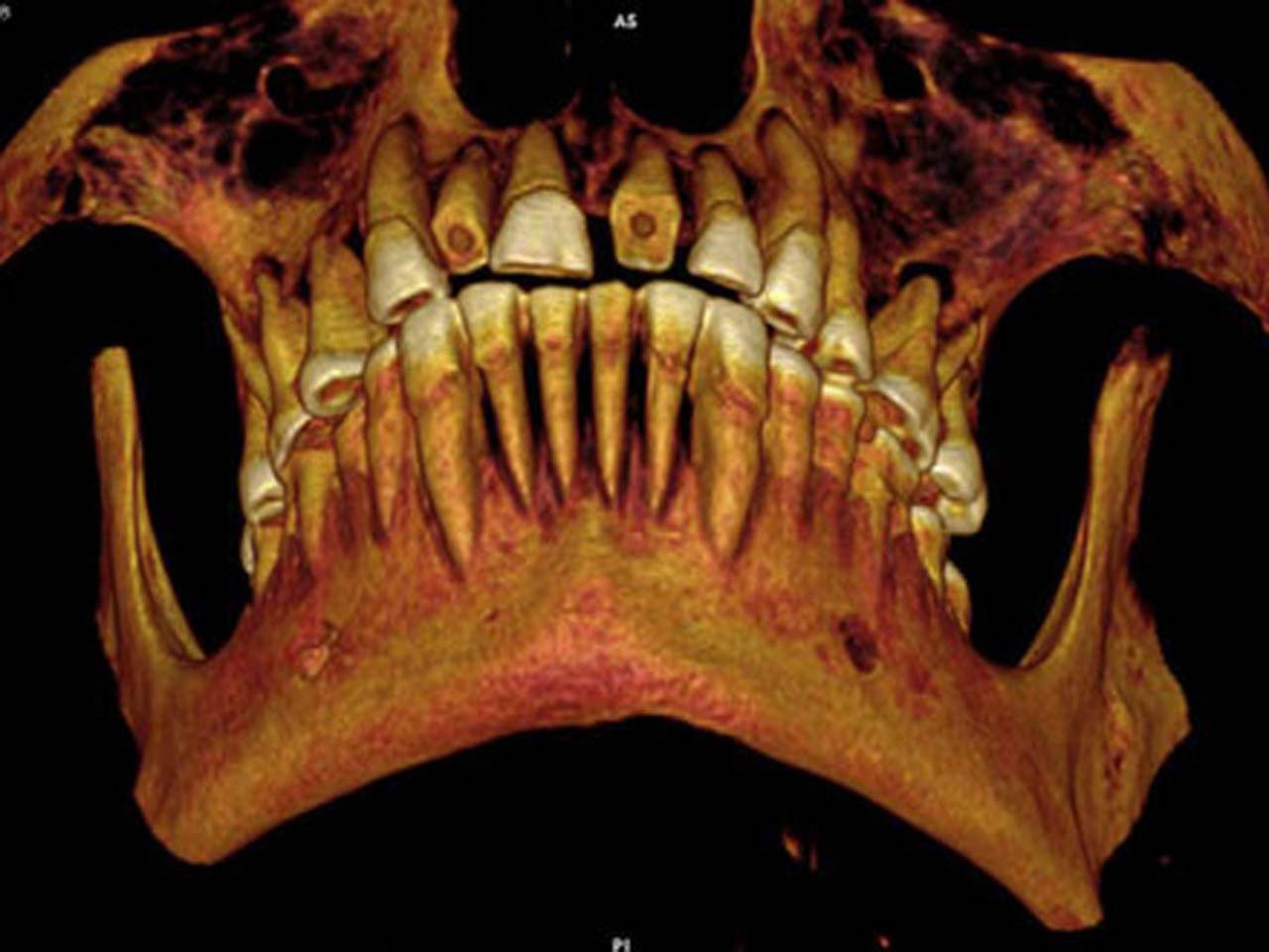 Mummy discovered with mouthful of cavities CBS News