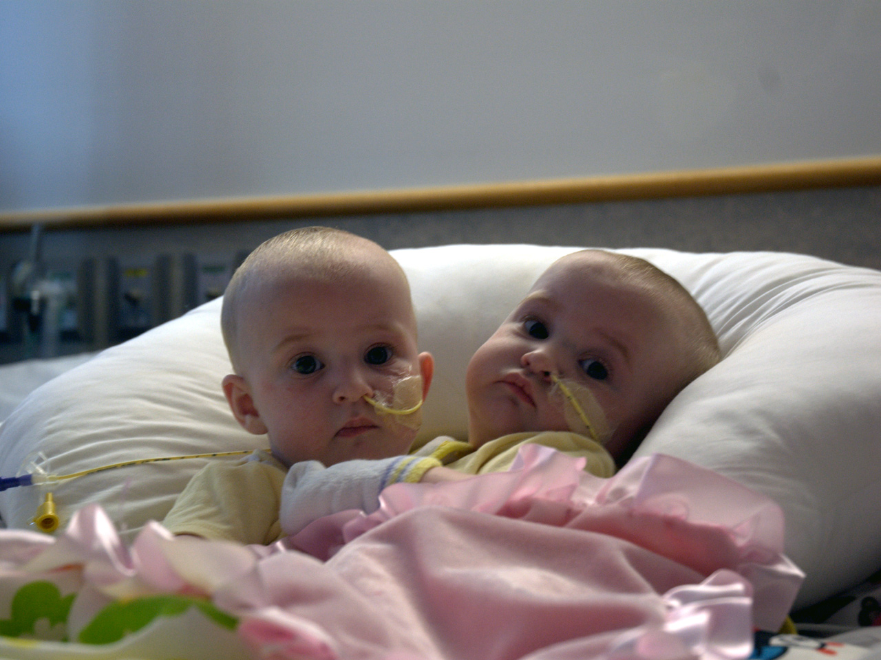 Conjoined Twin Girls Successfully Separated In Philly Cbs News