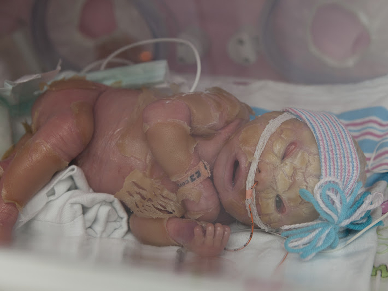 Meet Brenna, a baby with Harlequin Ichthyosis - Photo 5 ...