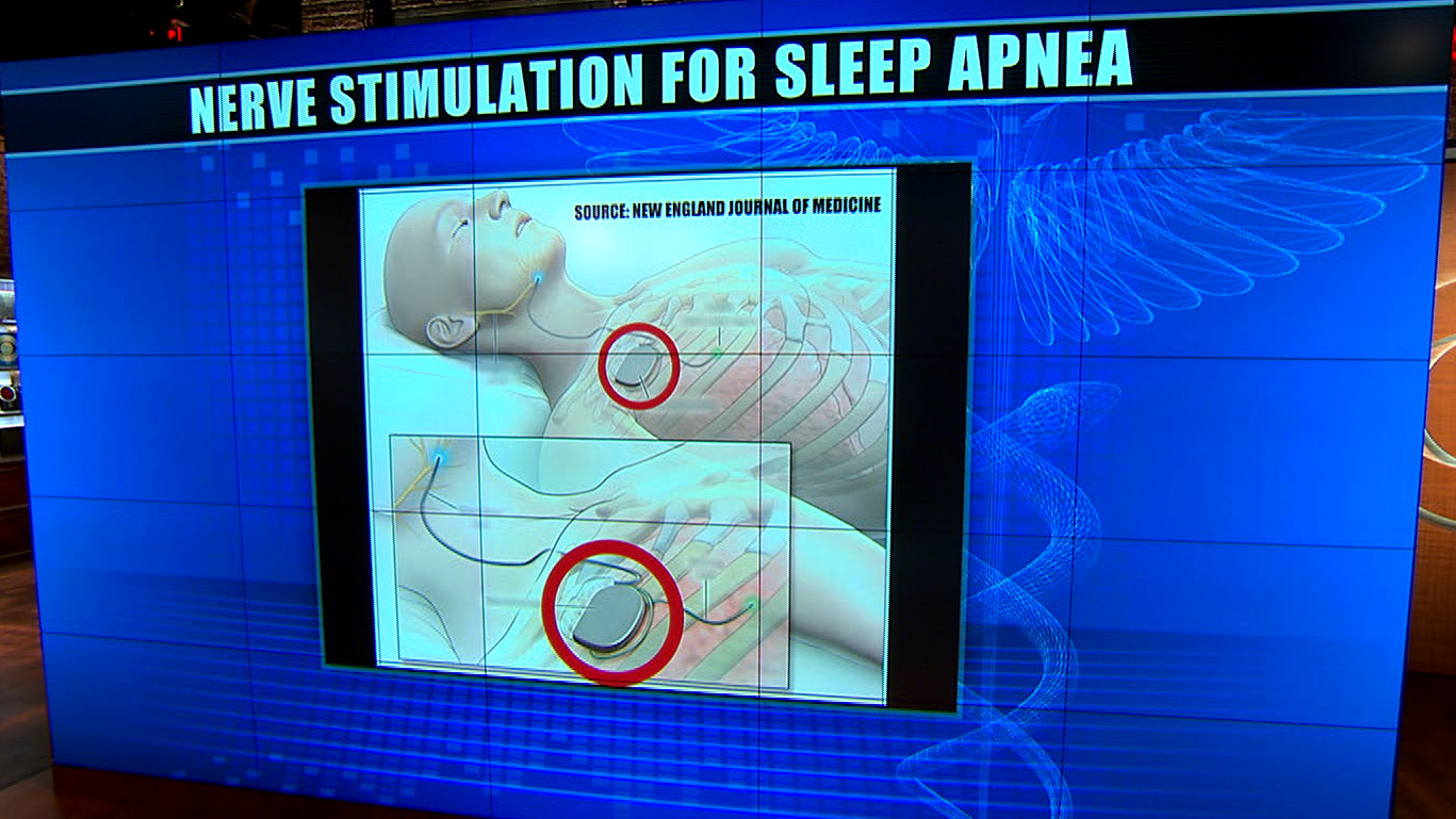 New Sleep Apnea Treatment Could Help Millions Cbs News