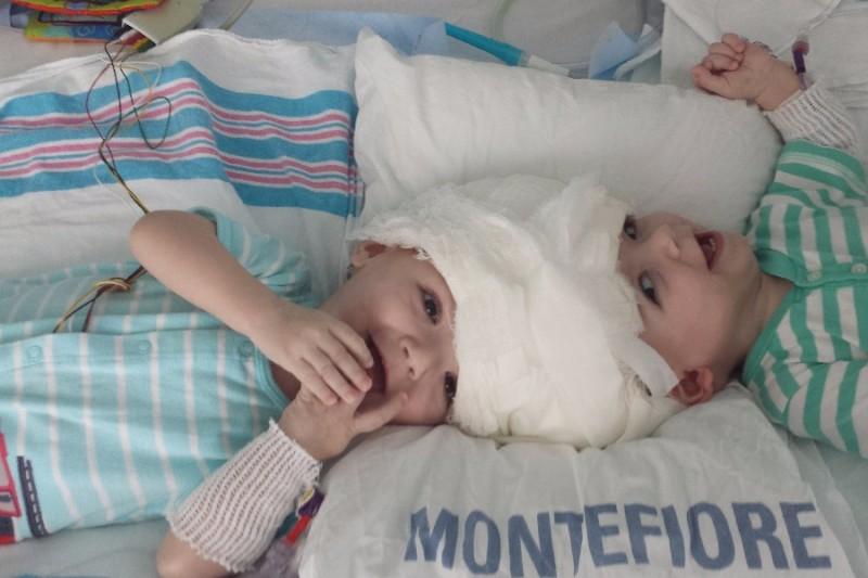 Conjoined twin boys, Jadon and Anias McDonald, separated in rare