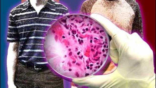 Resistant Strain Of Syphilis Found - CBS News