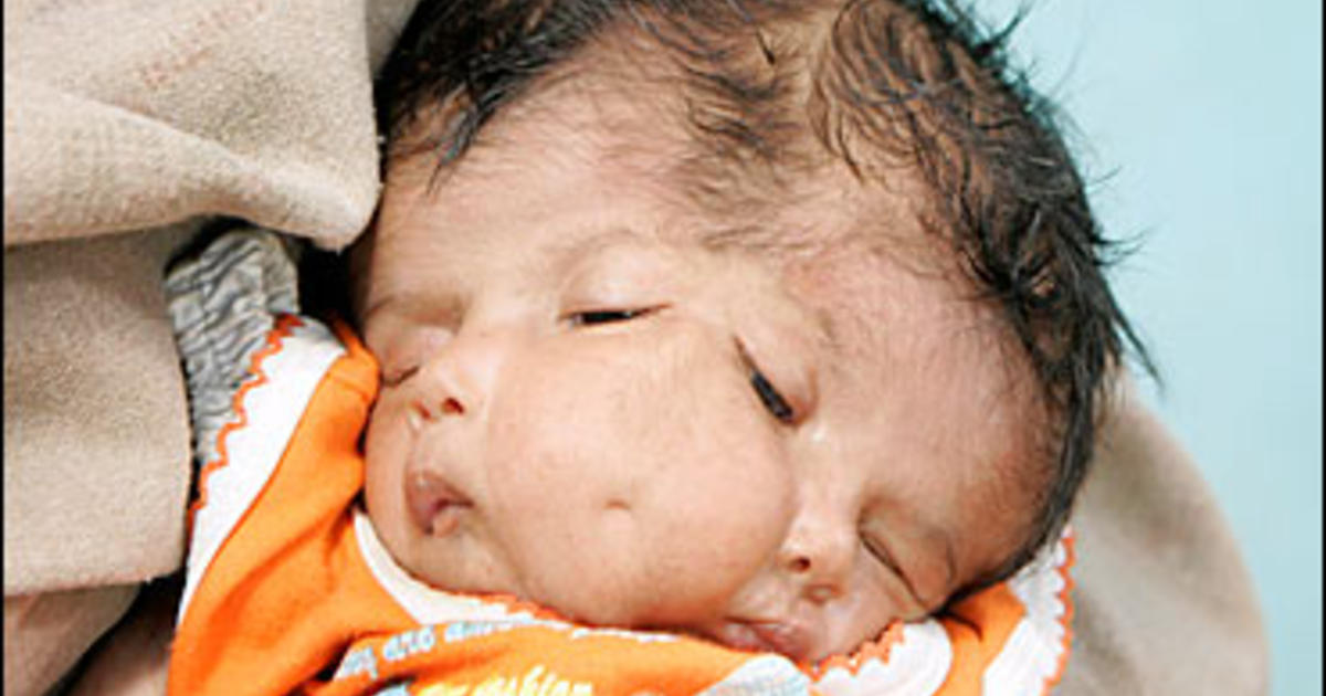 A baby with craniofacial duplication, a rare condition where the face and skull are duplicated.