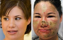 Bethany Storro: Vancouver Acid Attack Victim 