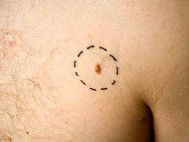 melanoma on man's chest