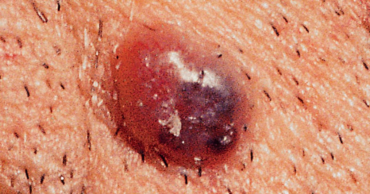 Is It Skin Cancer 38 Photos That Could Save Your Life PICTURES CBS 