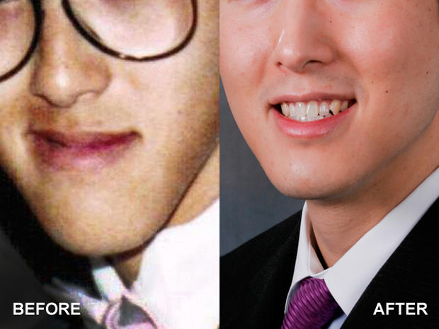 Upper Lip Lift 13 Bizarre But Popular Plastic Surgery Procedures Pictures Cbs News
