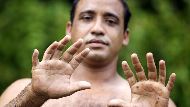 For Yoandri Hernandez Garrido, the answer is in his nickname - &quot;Twenty-Four.&quot; The 37-year-old Cuban man has a surprisingly common condition known as ... - polydactyly-AP110826017714
