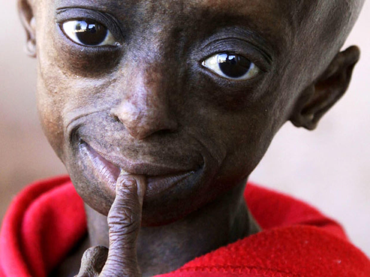 Progeria First black child with rare aging disease Photo 12