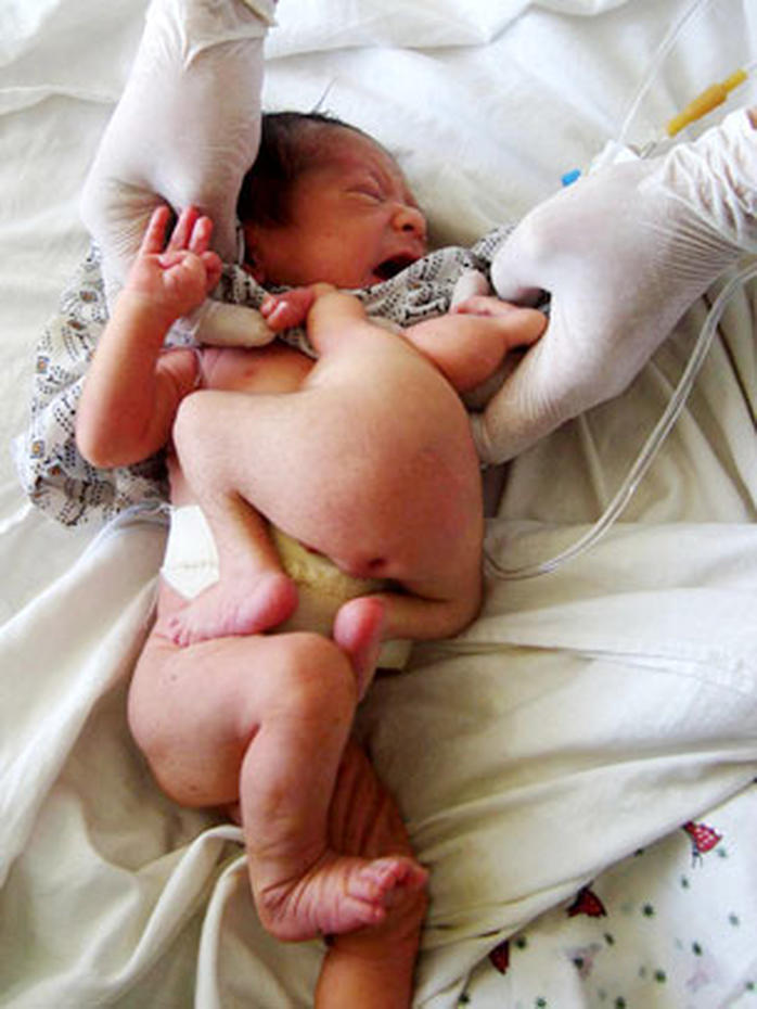 Conjoined twins 40 amazing photos (GRAPHIC IMAGES) Photo 26