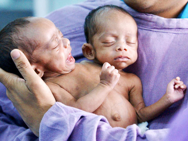 Conjoined Twins 40 Amazing Photos Graphic Images Photo 17 Pictures Cbs News 