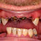 Meth Mouth Inside Look At Icky Problem Graphic Images Photo