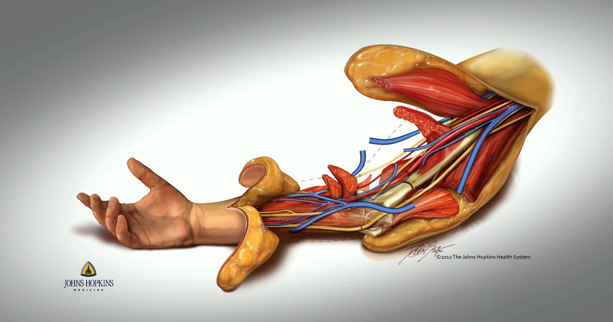 Hand transplant program for kids launched at Boston hospital CBS News