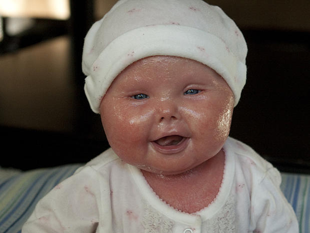 Meet Brenna, a baby with Harlequin Ichthyosis - Photo 17 ...