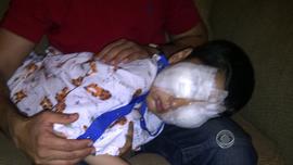 Sajad after surgery to repair his eyesight.