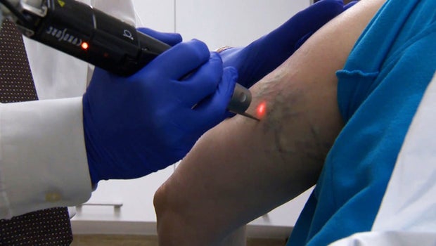 Faster laser tattoo removal treatment may get rid of tough