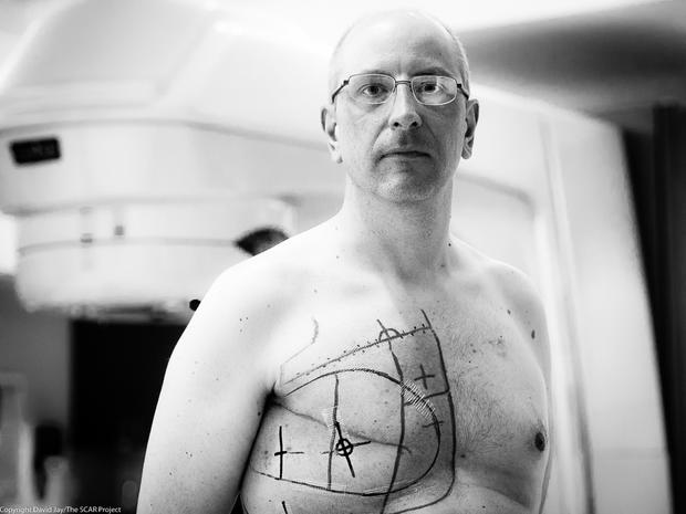 The SCAR Project - Picturing male breast cancer - Pictures 