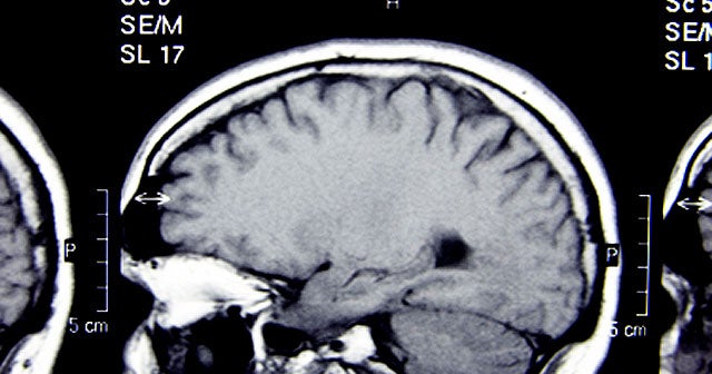 Teen Brain Scans Offer Clues About Mental Illness