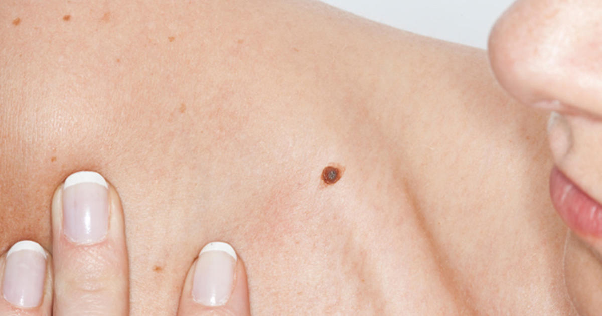 itching mole on breast