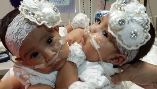 Conjoined twins Knatalye Hope and Adeline Faith Mata of Houston, Texas, will undergo separation surgery in February. - conjoinedtwingirls