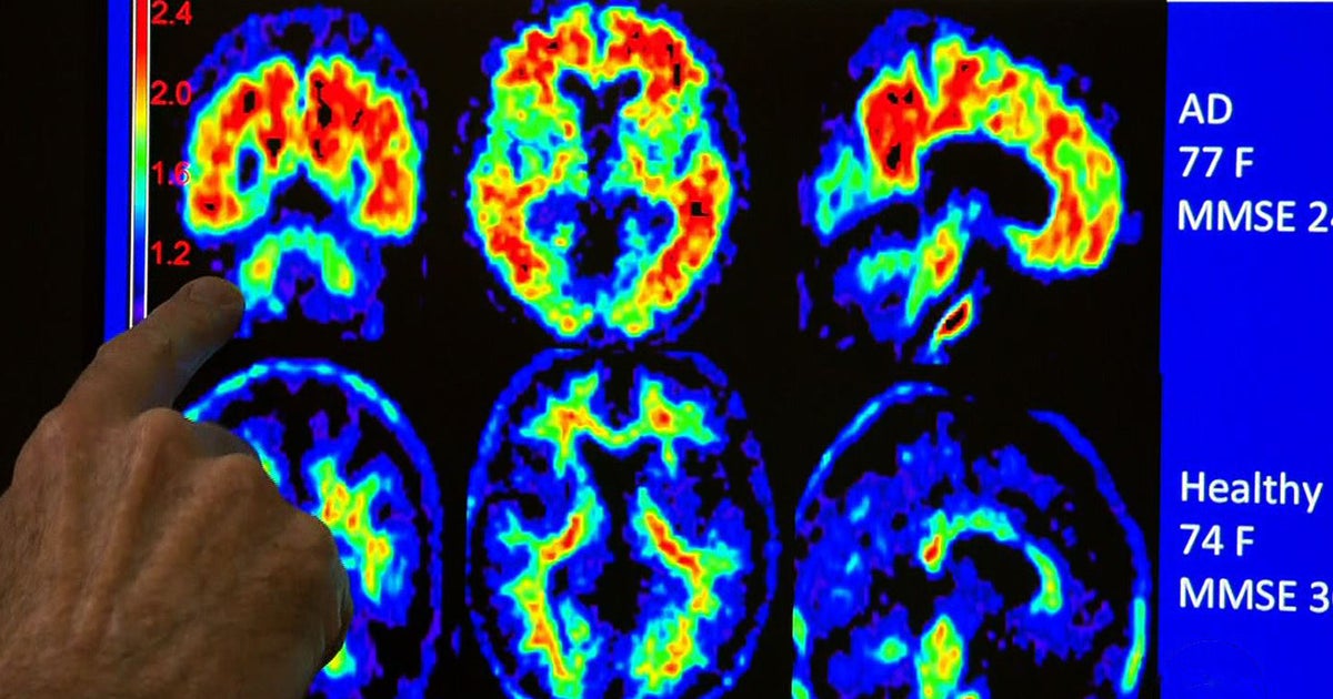 Experimental ultrasound treatment targets Alzheimer's brain plaque CBS News