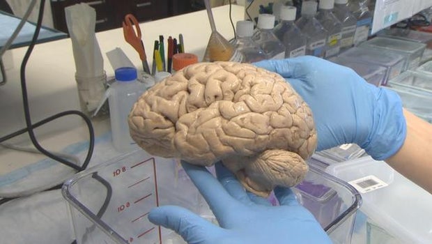 How autism brain bank my help find a cure