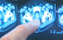 Prostate cancer treatment linked to Alzheimer's