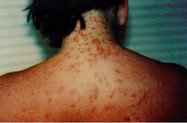 sea-lice-rash.png
