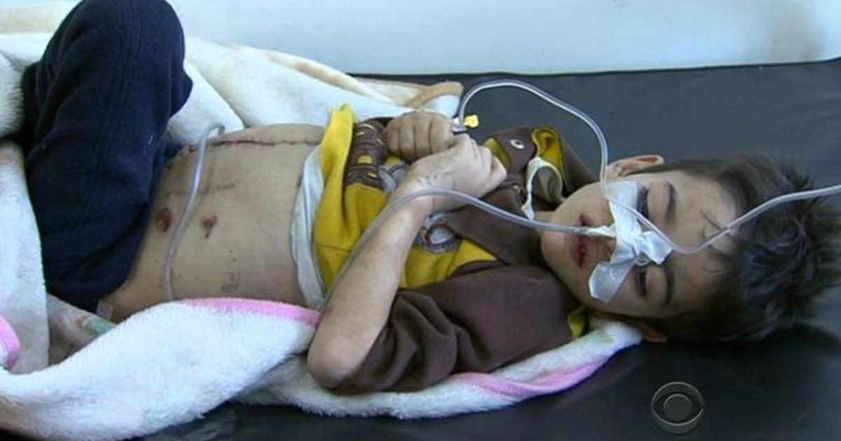 Aleppo boy finally gets surgery, two weeks after he was hurt in airstrike