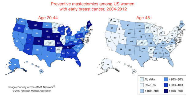 mastectomy-maps.jpg 