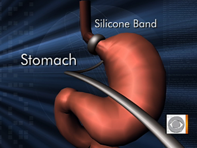 Lap band surgery availability widened CBS News