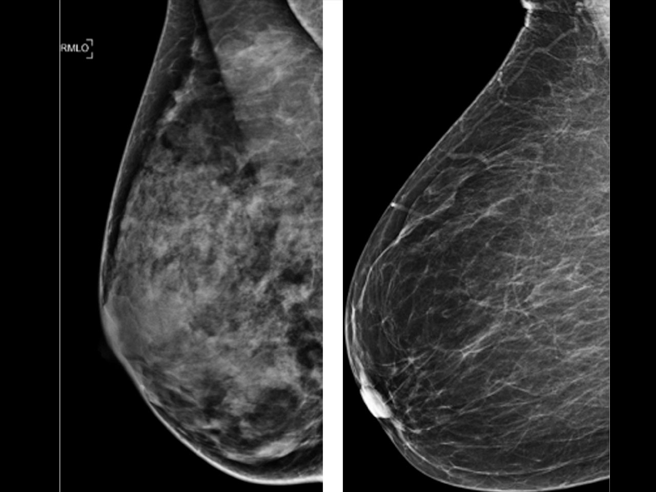 mammogram-study-dense-breasts-won-t-raise-cancer-death-risk-in-women