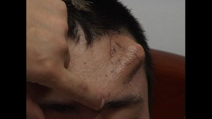 Man S Nose Grown On Forehead Ahead Of Transplant Cbs News