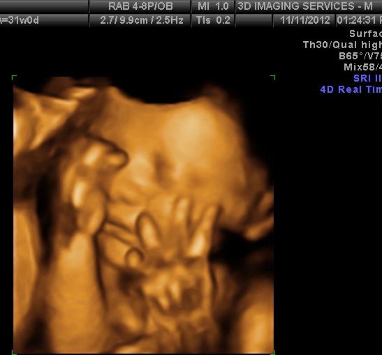 3D ultrasounds cause concern for OBGYN doctors and FDA CBS News