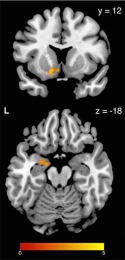 brain-scan-stress-eating-250w.jpg
