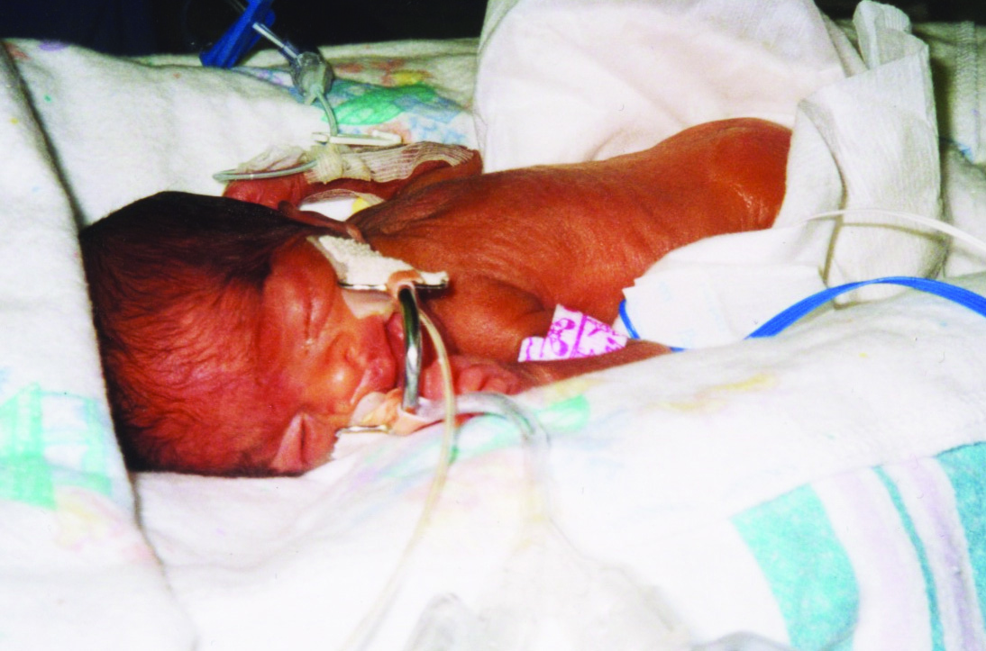 Premature Babies And Their Chances Of Survival