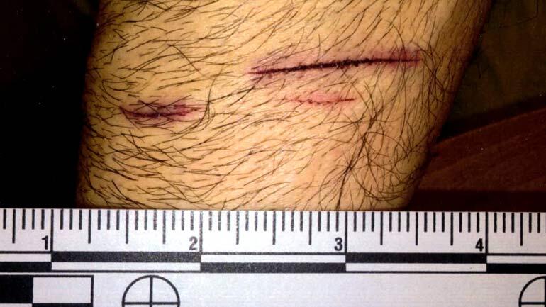 Scratches on Art Gonzales' arm