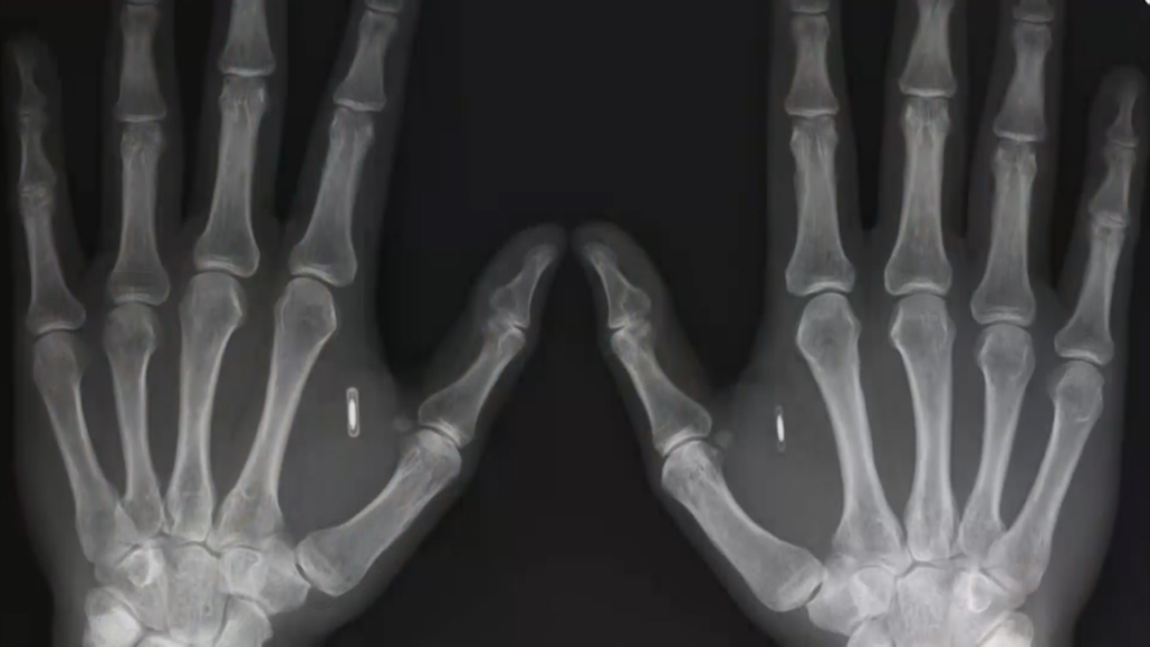 meet-the-humans-with-microchips-implanted-in-them-cbs-news