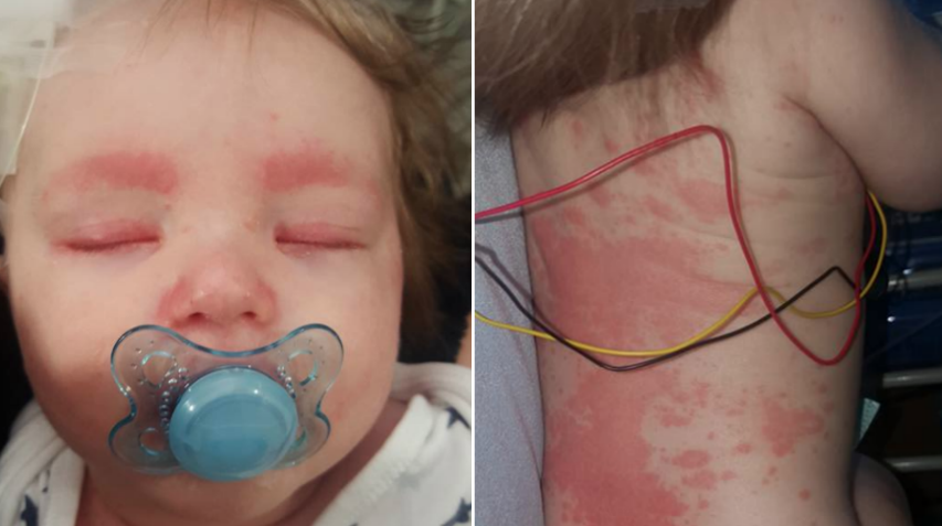 Meningitis rash completely covers baby's body in 12 hours, mom warns