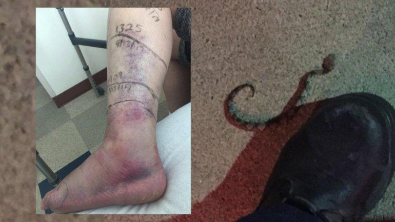 Mother Recovering From Copperhead Snake Bite At Virginia Restaurant Cbs News