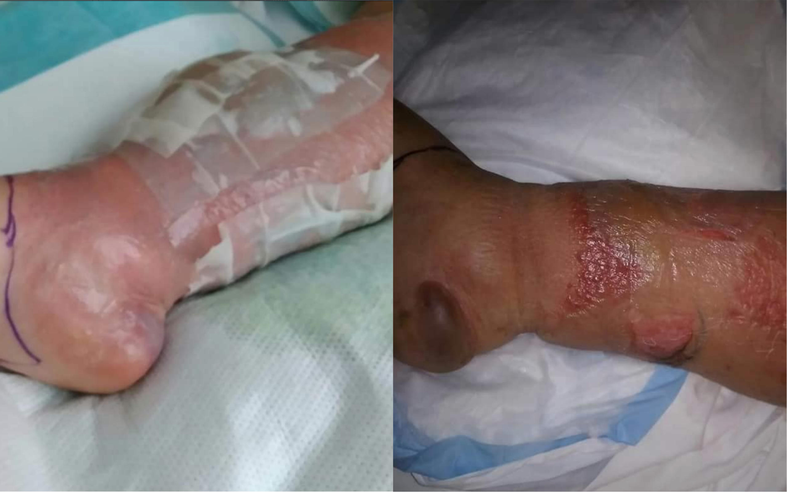 Woman almost loses leg after getting infection she blames on ...