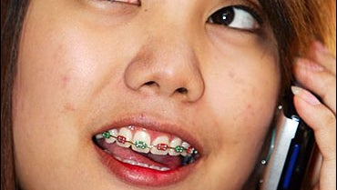 Crackdown On Fake Braces Fashion Fad - CBS News