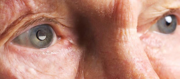 Left eye implanted with Implantable Miniature Telescope. (VisionCare)
