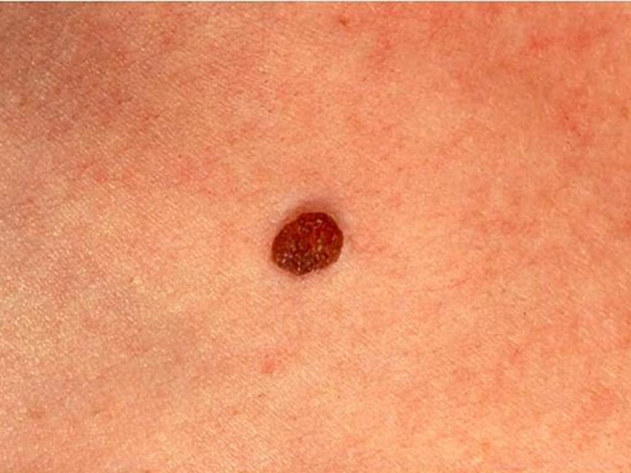 Skin Cancer Or Mole How To Tell Cbs News