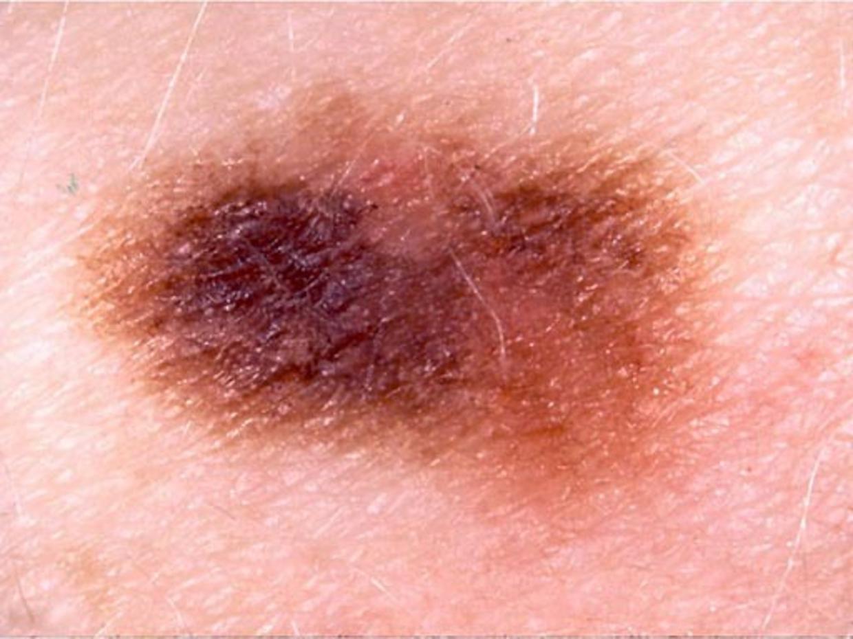 Skin Cancer Or Mole How To Tell Cbs News 