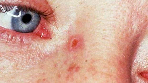 Skin cancer or mole? How to tell 