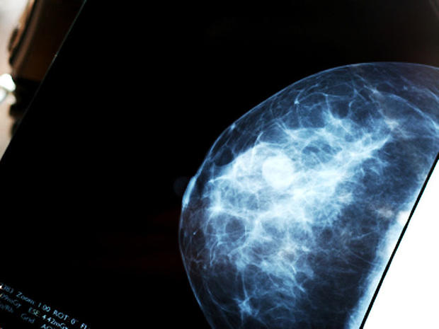 mammogram 