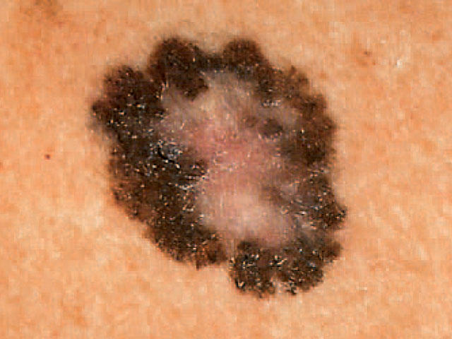Is It Skin Cancer Cbs News