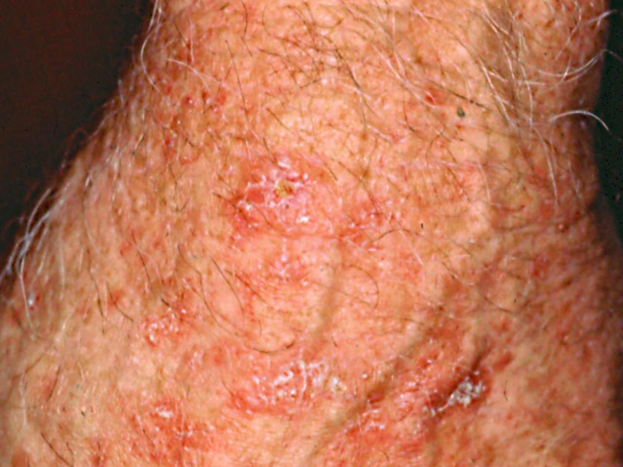 Skin Cancer Lesion On Back